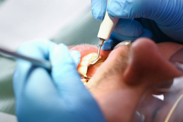 Best Emergency Tooth Extraction in Zapata, TX